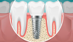 Dental implants