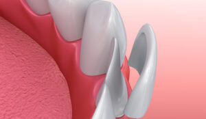 Dental Veneers