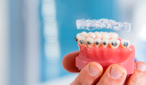 aligners and braces