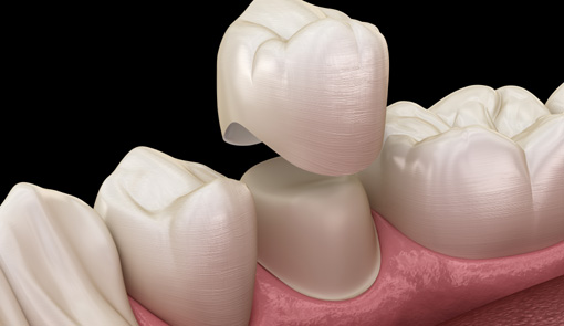 Dental crown premolar tooth