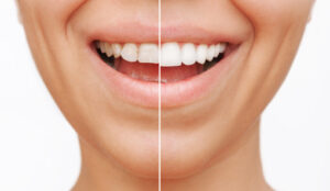 smiling woman before and after veneers