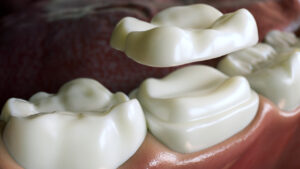 Ceramic Overlay crown over a tooth 3D Rendering